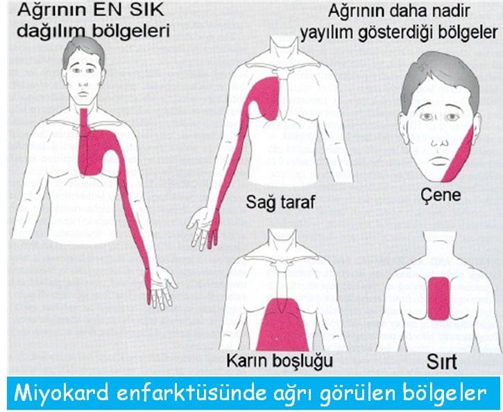 Miyokard enfarktüsü sırasında vücudun bazı yerlerinde ağrı oluşur.