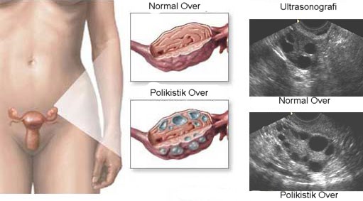 polikistik over