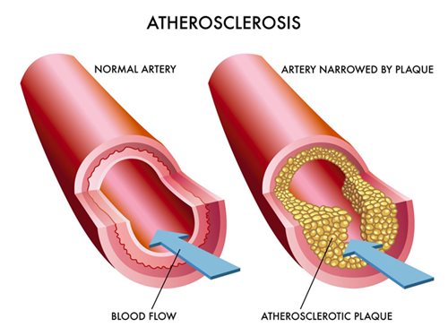 ateroskleroz