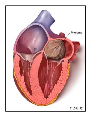 kalp tümörü